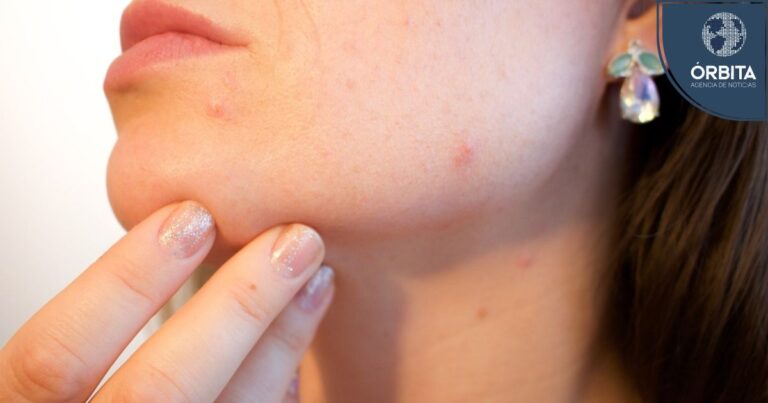 ¿Granitos en el rostro? Descubre qué es el acné cosmético y como combatirlo