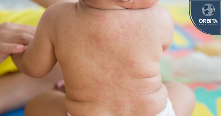 ¡Alerta por rebrote de meningitis meningocócica! Falta de monitoreo agrava la crisis sanitaria en el Perú