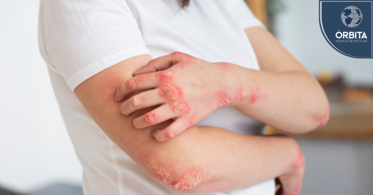 Avance en el tratamiento de la psoriasis en Perú