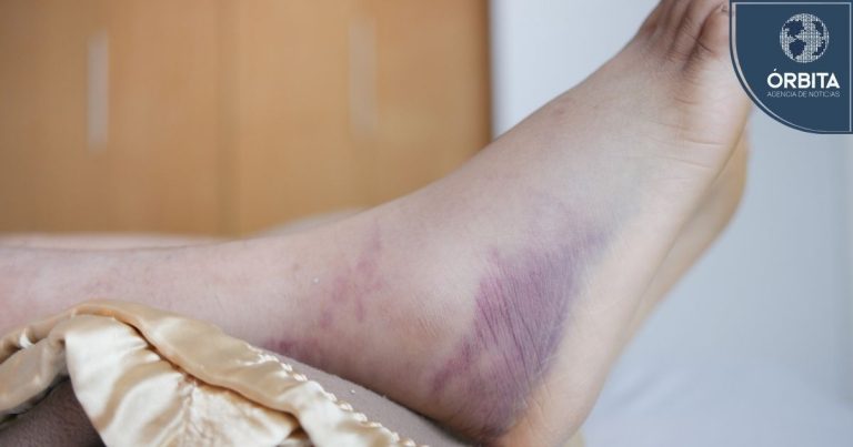 La hemofilia en Perú: una infancia limitada por la falta de tratamiento oportuno