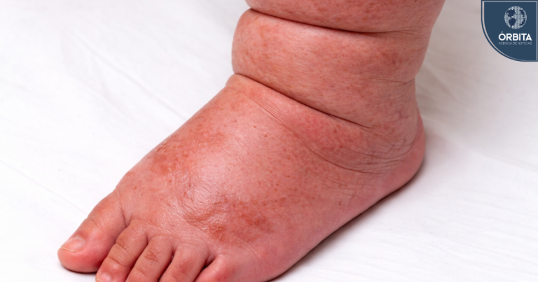 Hinchazón que no desaparece: ¿Cuándo sospechar de linfedema?